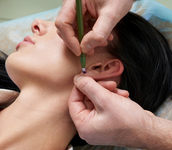 تجميل الأذن بدون جراحة